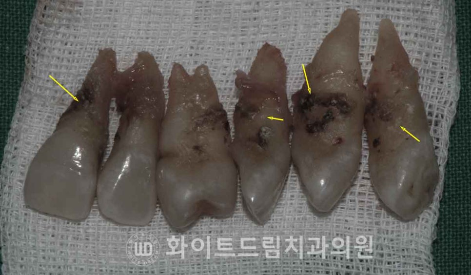서울전체임플란트 / "경상도에서 왔어요." 치주염으로 인한 앞니 돌출 치료 (+서울전체임플란트 내원 횟수는?) 관련 이미지 10