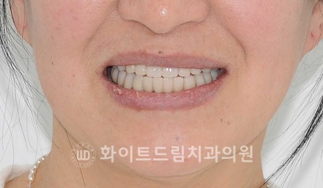 강남역전체임플란트 / 발치 후 즉시 식립, 무조건 누구나 3개월로 끝낼 수 있는 것일까? 강남역화이트드림치과 관련 이미지 19