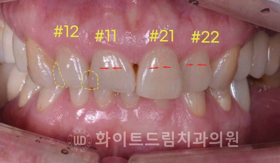 신논현역 당일 라미네이트, "길이가 다른 깨진 앞니" 당일 앞니 라미네이트 치료 과정은? 관련 이미지 4