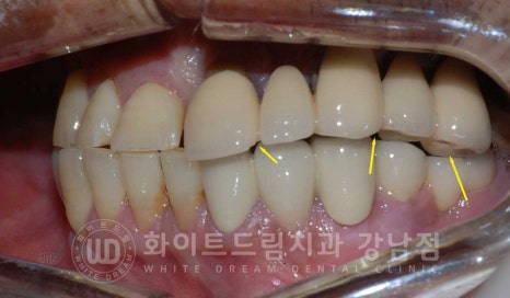 임플란트 재수술의 주원인, "임플란트 주위염과 임플란트 찢어짐!" 관련 이미지 7
