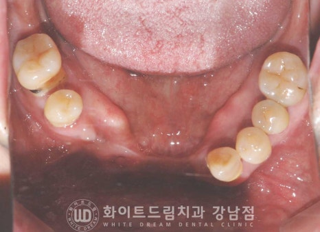 치주염 전체임플란트, 염증으로 인한 상악동 천공 & 신경관 가까이 녹은 잇몸뼈. 임플란트 식립 가능할까? 관련 이미지 18