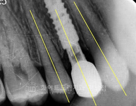 영구치 결손, "유치가 흔들려요." 성인 잔존 유치 발치 후 바로 임플란트 식립! 관련 이미지 9