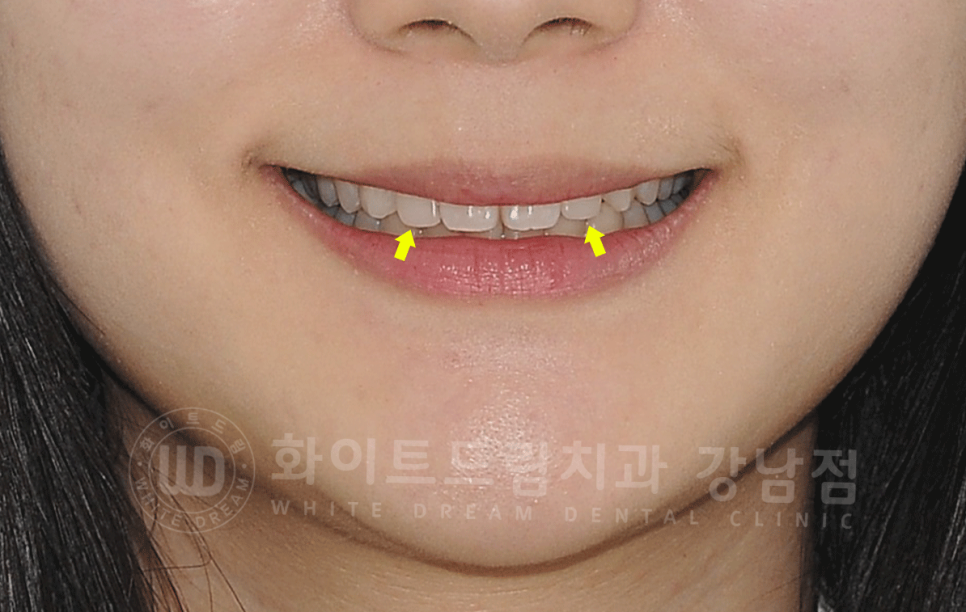 강남역 심미치과 "치아 하나가 유난히 작아요" #왜소치라미네이트 관련 이미지 10