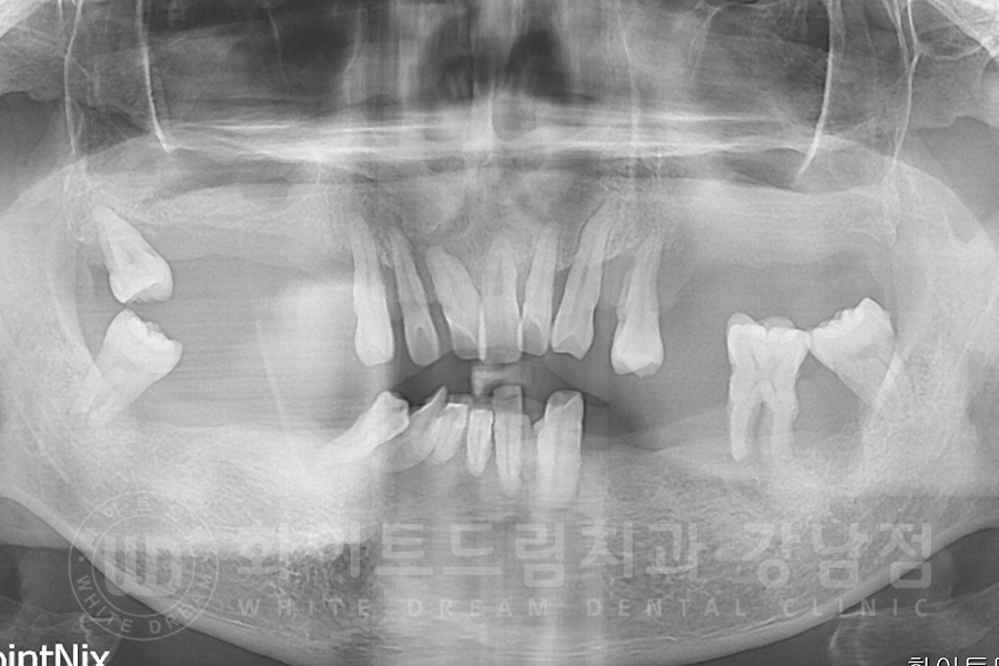 강남역 전체임플란트 치과 "치아가 심하게 흔들려요." 심한 치주염 임플란트 치료 관련 이미지 4