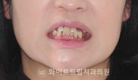 서울전체임플란트 / "경상도에서 왔어요." 치주염으로 인한 앞니 돌출 치료 (+서울전체임플란트 내원 횟수는?) 관련 이미지 5