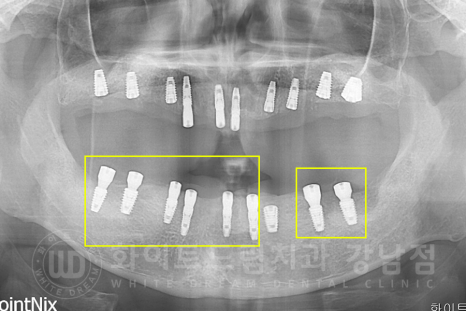 강남역 전체임플란트 치과 "치아가 심하게 흔들려요." 심한 치주염 임플란트 치료 관련 이미지 14