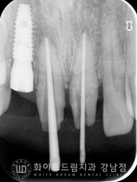 사고당한 앞니치료, "흔들리고 점점 변색돼요." 앞니 임플란트 & 신경치료 관련 이미지 7
