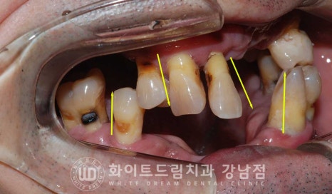 치주염 전체임플란트, 염증으로 인한 상악동 천공 & 신경관 가까이 녹은 잇몸뼈. 임플란트 식립 가능할까? 관련 이미지 5