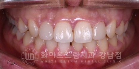 역삼역 왜소치치료 / 치아 하나가 너무 작아요. 왜소치 라미네이트 잘하는 치과 관련 이미지 11