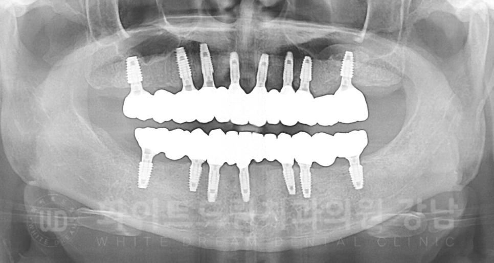 강남역 임플란트 치과 "틀니가 안 맞아서 불편해요" 틀니 → 전체 임플란트로! 관련 이미지 21