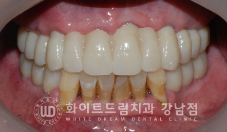 상악 풀케이스임플란트 사례 / "지인 추천으로 인천에서 왔어요." 관련 이미지 15