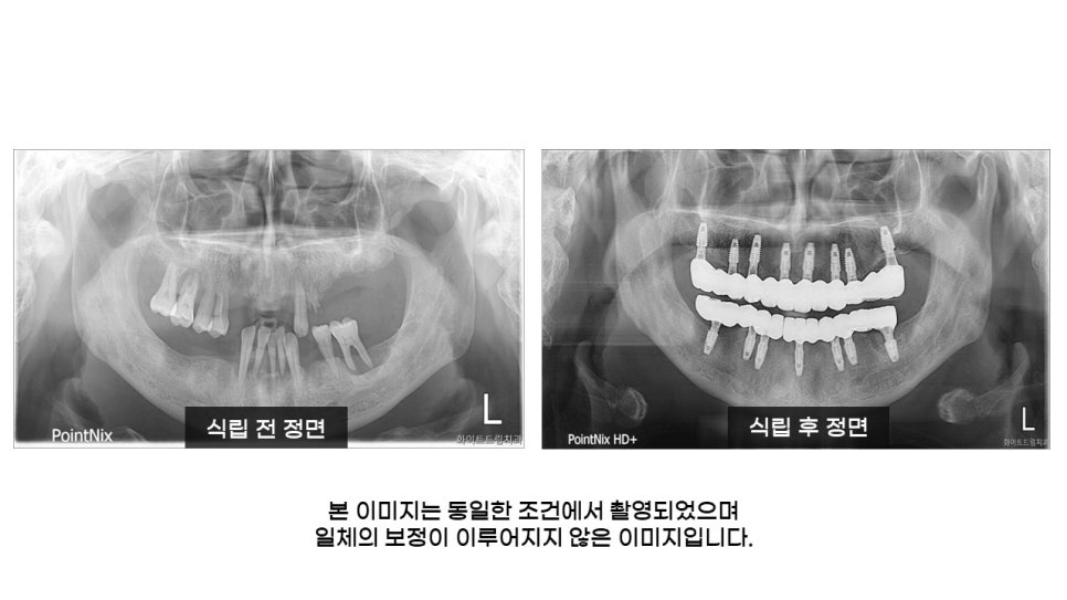 40대임플란트식립후기 및 어금니임플란트 가격, 종류 알아보기 위해 관련 이미지 22