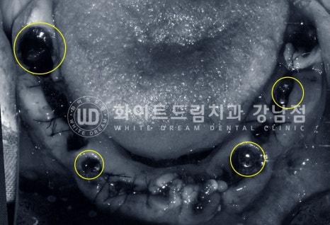 40대 전체임플란트 / 디지털스캔바디를 이용한 전체 임플란트 치료 사례 (Feat. 치주염) 관련 이미지 17