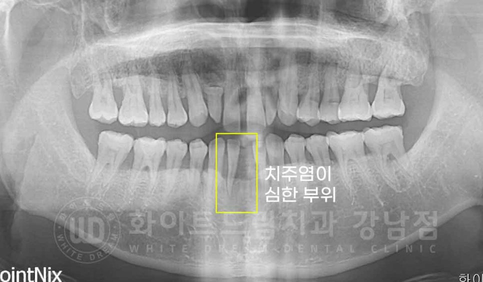 강남역 결손치 "앞니 두 개가 없고, 벌어졌어요" 결손치 치료 방법 관련 이미지 15