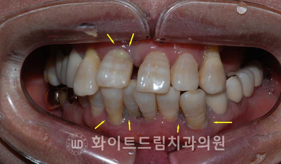 강남역전체임플란트 / 발치 후 즉시 식립, 무조건 누구나 3개월로 끝낼 수 있는 것일까? 강남역화이트드림치과 관련 이미지 5