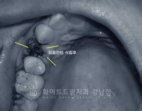 영구치 결손, "유치가 흔들려요." 성인 잔존 유치 발치 후 바로 임플란트 식립! 관련 이미지 8