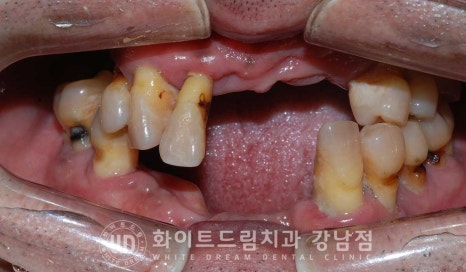 치주염 전체임플란트, 염증으로 인한 상악동 천공 & 신경관 가까이 녹은 잇몸뼈. 임플란트 식립 가능할까? 관련 이미지 20