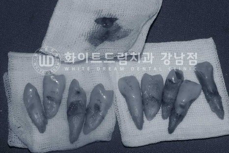 강남역 전악임플란트치과 / 치주 질환이 치아와 임플란트에 끼치는 영향! 관련 이미지 9