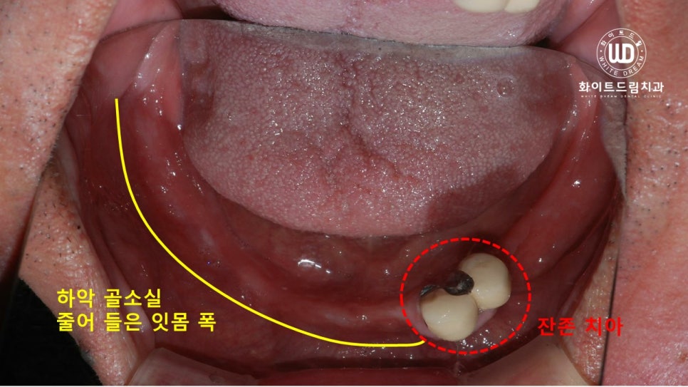 전체 치조골 이식을 동반한 고혈압 환자 임플란트 사례 관련 이미지 1