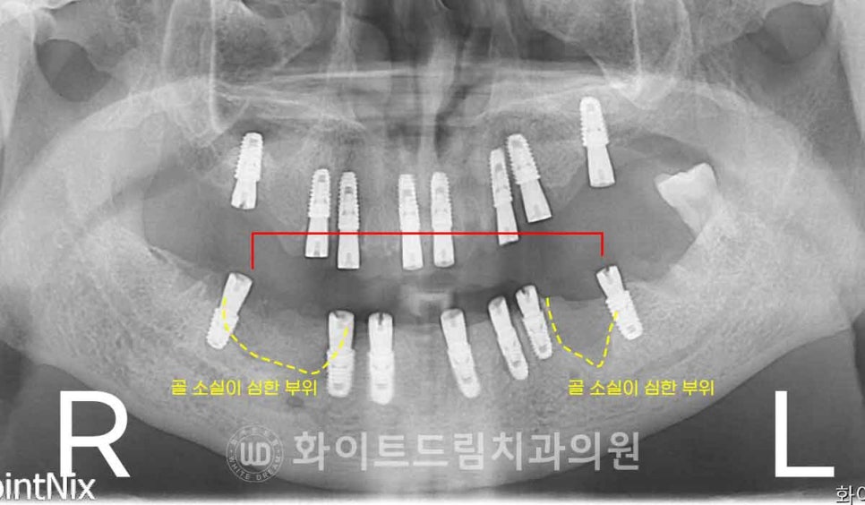 서울전체임플란트잘하는치과, 왜 치주염이 심해지면 반대교합까지 생길까요? (치주염 전체 임플란트 CASE) 관련 이미지 15
