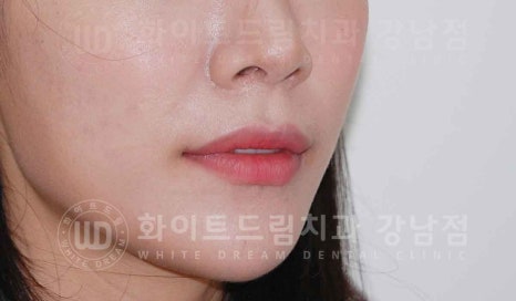 강남역 나비앞니 라미네이트 / "투명교정과 라미네이트 치료" 강남역 화이트드림치과 관련 이미지 19