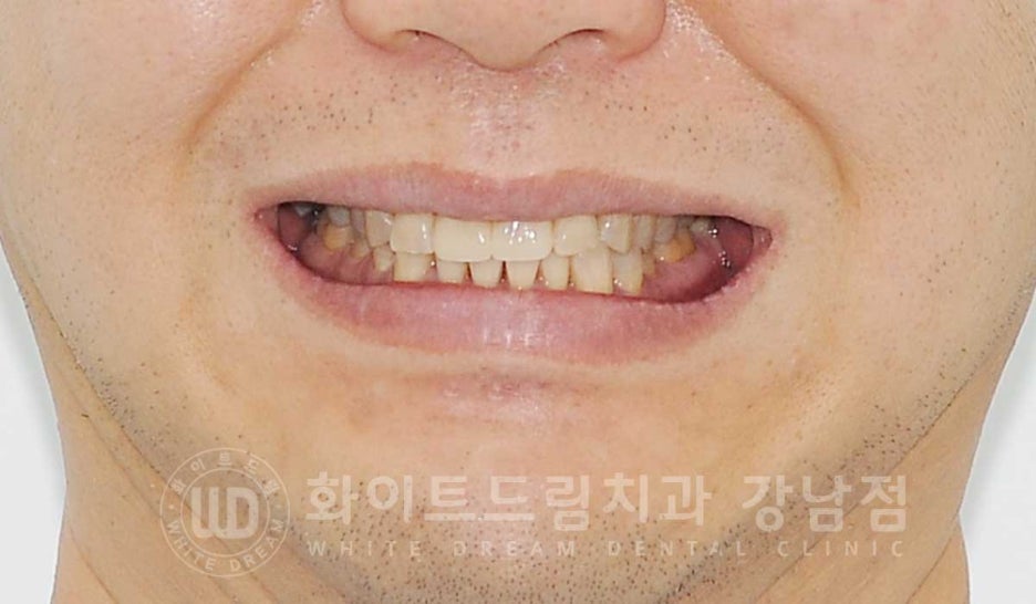 앞니 레진변색 "너무 지저분해 보여요." 라미네이트로 깔끔하게 교체한 치료 사례 관련 이미지 2