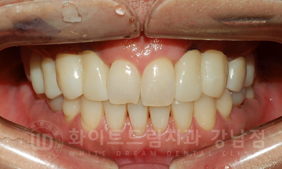 강남역 치과브릿지 "브릿지가 흔들려요" 흔들리는 브릿지 치료는? 관련 이미지 13