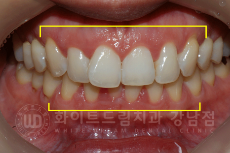강남역 앞니라미네이트 "틀어진 토끼 앞니 빠르게 개선" 강남역 라미네이트 치과 관련 이미지 6