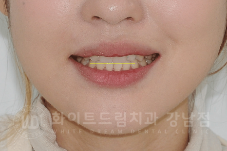 강남역 주변 치과 "10년 된 앞니가 변색됐어요" 앞니 심미 치료 관련 이미지 11