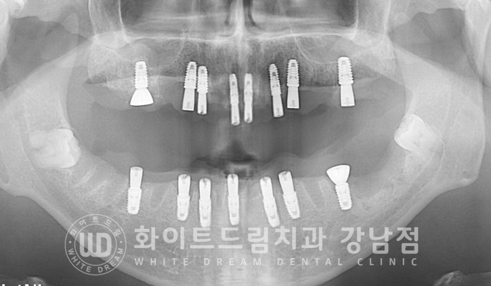 40대 전체임플란트 / 디지털스캔바디를 이용한 전체 임플란트 치료 사례 (Feat. 치주염) 관련 이미지 12