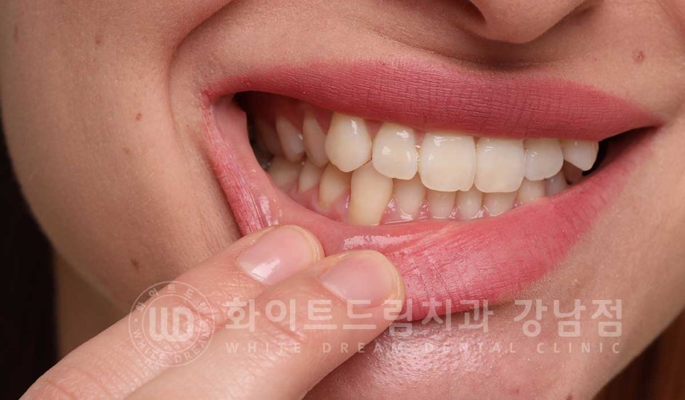 노화된 치아 라미네이트 / 치아미백을 해도 하얘지지 않는 마모된 치아는 어떻게 할까? 관련 이미지 2