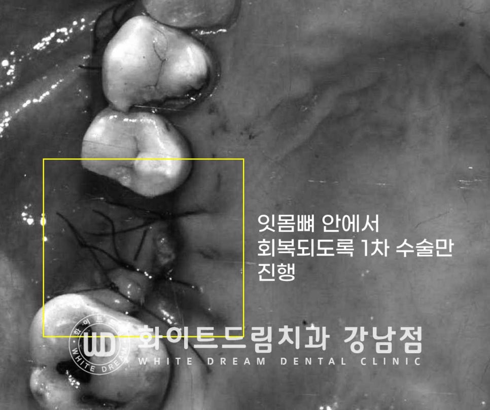 상악 어금니 임플란트 치료 시 동반되는 "상악동 거상술" 이란? 관련 이미지 7