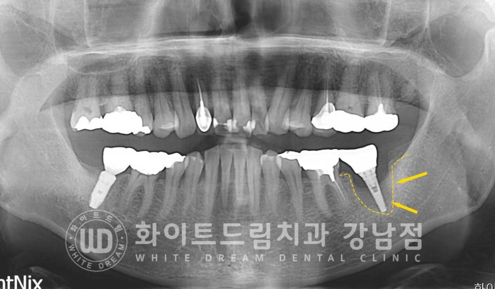 강남역 임플란트재수술 치과 / "임플란트가 흔들려요!" 임플란트 주위염 관련 이미지 4