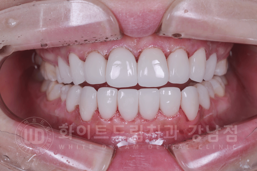 강남역 원데이 라미네이트 "유튜브 촬영하는데 치아가 신경 쓰여요" #강남화이트드림치과 관련 이미지 14