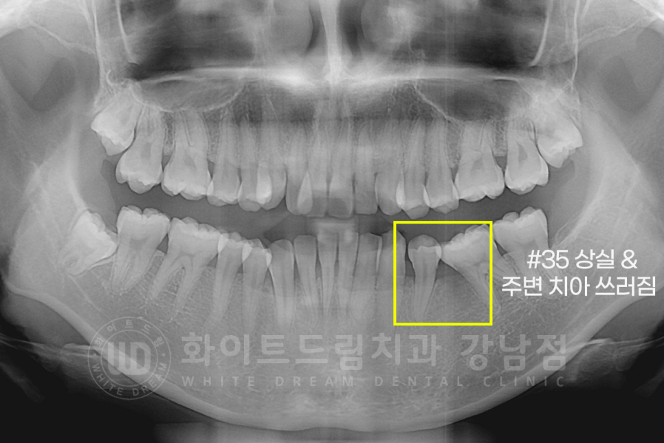 강남 덧니 비발치교정 / 임플란트와 치아교정 동시 진행 case 리뷰. 관련 이미지 9