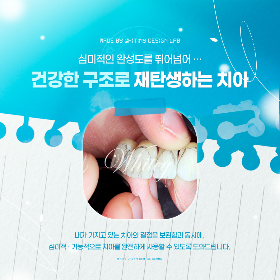 라미네이트 치료에 대해 알아보면? 관련 이미지 8