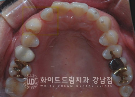 앞니 원데이라미네이트 / 떨어진 앞니 레진 & 벌어진 앞니, 라미네이트로 당일 개선 ★ 관련 이미지 2