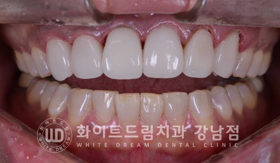 깨진앞니 라미네이트 / 깨지고 누렇게 변한 앞니는? 원데이 라미네이트 치료 사례 관련 이미지 11