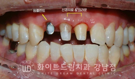 사고당한 앞니치료, "흔들리고 점점 변색돼요." 앞니 임플란트 & 신경치료 관련 이미지 11