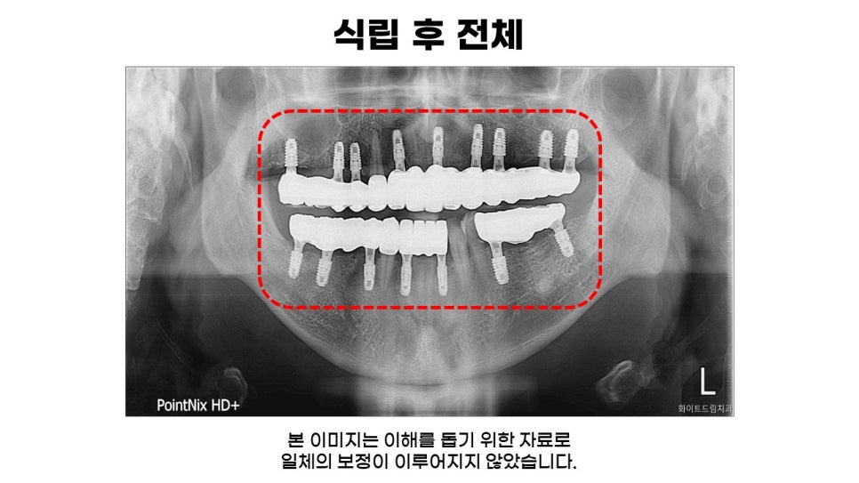 고연령 전체임플란트 과정 및 임플란트 치료기간, 전체임플란트식립후기 관련 이미지 7