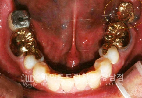 강남역 임플란트재수술 치과 / "임플란트가 흔들려요!" 임플란트 주위염 관련 이미지 5