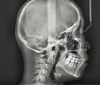 임플란트 하기 전 알아보아야 할 것. 관련 이미지 27