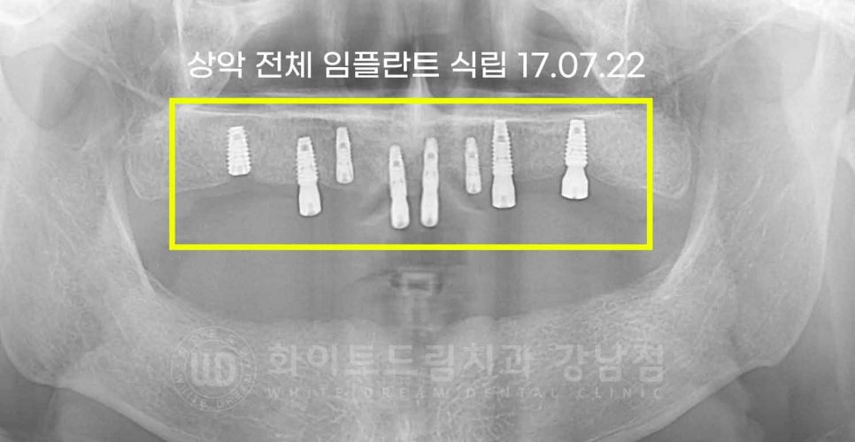 강남역 전악 임플란트 "치아가 흔들리고 빠져요!" 치주염 임플란트 치료 관련 이미지 7
