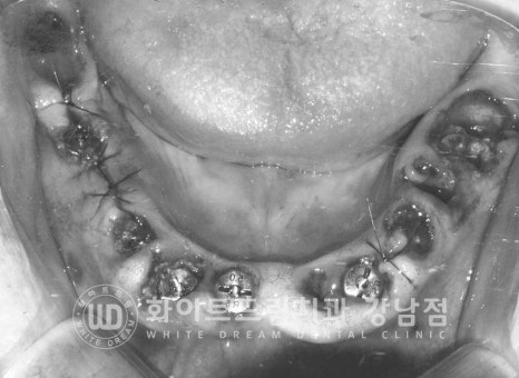 전체 임플란트 치료 기간과 내원 횟수는? "치과에 자주 가기 어려워요." 관련 이미지 14