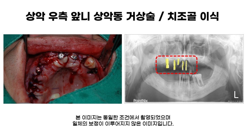 40대임플란트식립후기 및 어금니임플란트 가격, 종류 알아보기 위해 관련 이미지 5