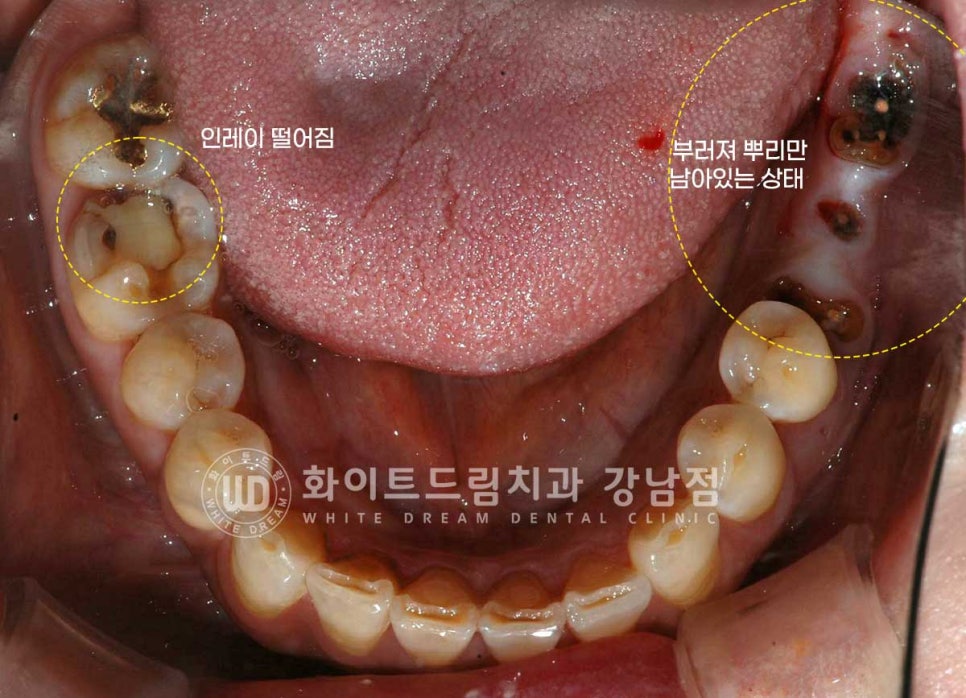 신경치료 후 크라운을 해야 하는 이유 / 크라운을 안 해 부러진 치아 임플란트 치료 case 관련 이미지 5