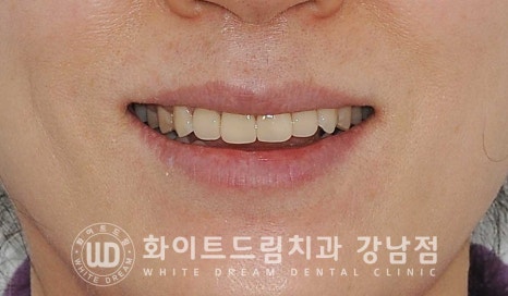 벌어진 앞니 라미네이트 / 50대 시니어 라미네이트 치료 사례 관련 이미지 10