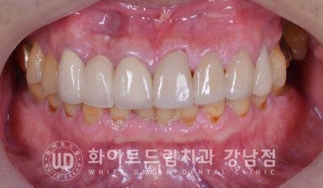 앞니 충치 라미네이트 치료 / "옆 크라운과 치아 색상을 맞추고 싶어요" 관련 이미지 3