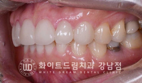 앞니 원데이라미네이트, 뻐드러지고 벌어진 앞니! 당일 치료 ok 관련 이미지 12