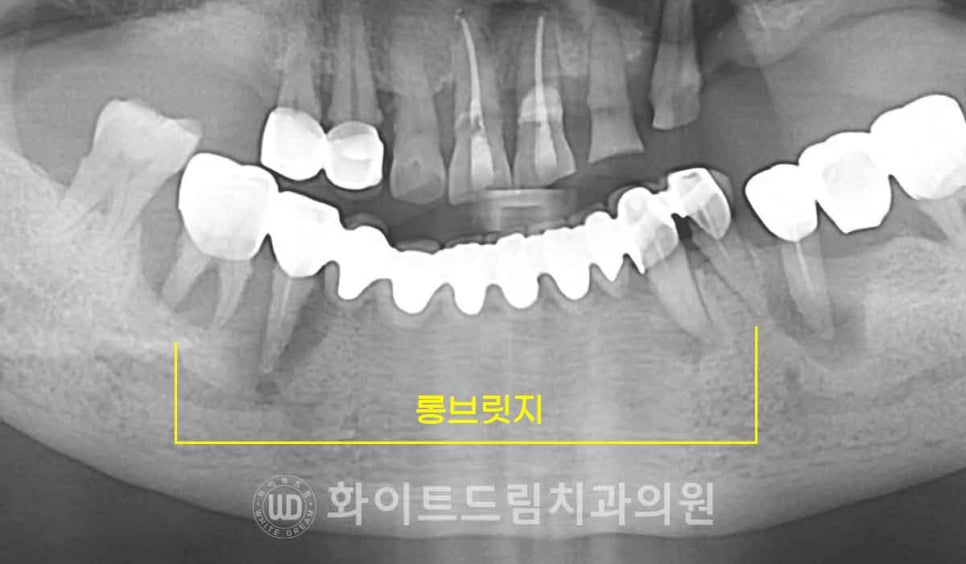 서울전체임플란트잘하는치과, 왜 치주염이 심해지면 반대교합까지 생길까요? (치주염 전체 임플란트 CASE) 관련 이미지 12